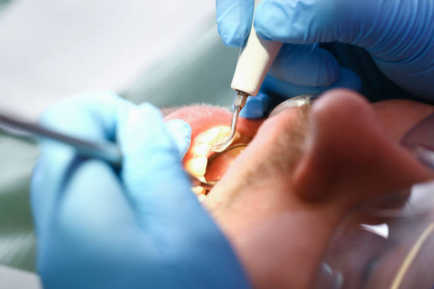 Best Emergency Dental Care for Abscessed Tooth in Fort Bragg, CA